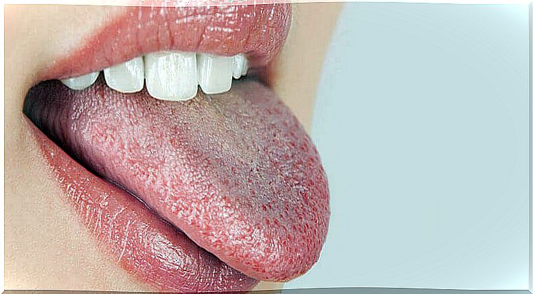 A woman sticks out a dry tongue, which could be an early warning sign of diabetes.