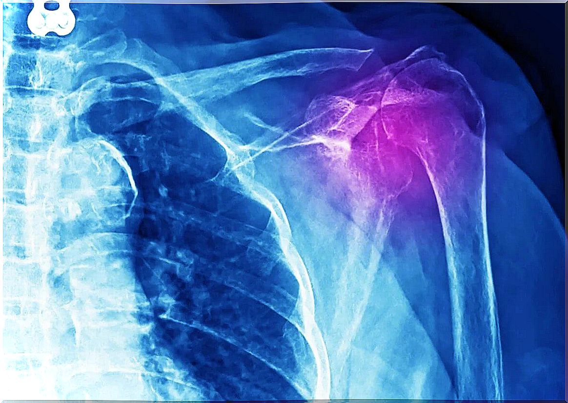 X-ray tendinitis on the shoulder