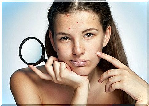 6 tips against acne