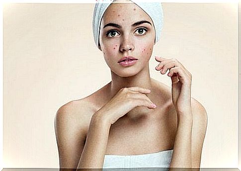 Woman needs tips against acne