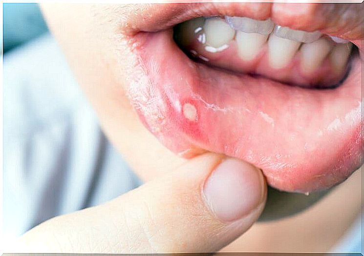 7 home remedies for mouth ulcers