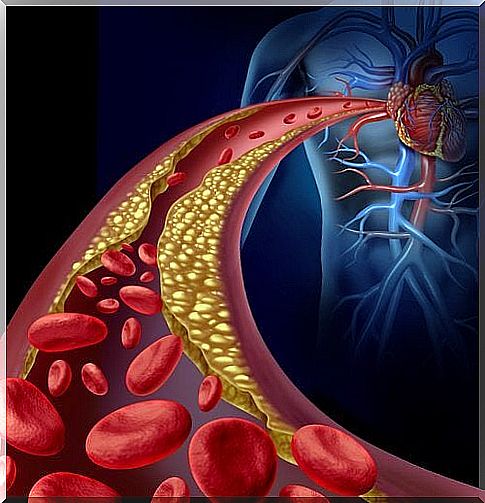 Atherosclerosis complications