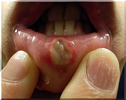 Treatment of aphthous ulcers