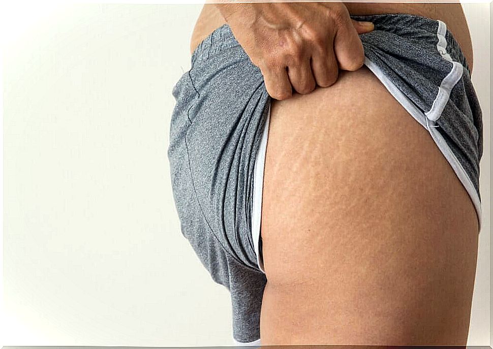 Coconut oil for stretch marks and scars