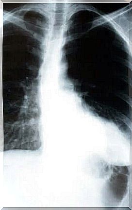 Detect silent pneumonia through an x-ray