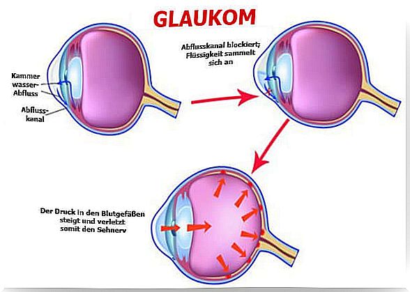 glaucoma