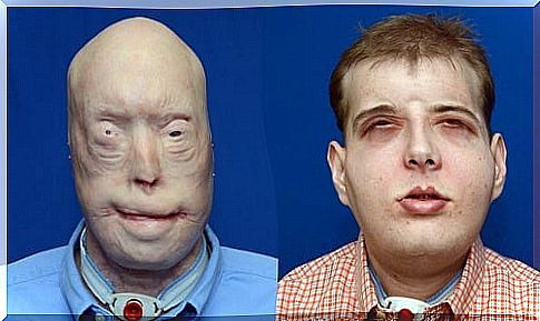 Historic face transplant