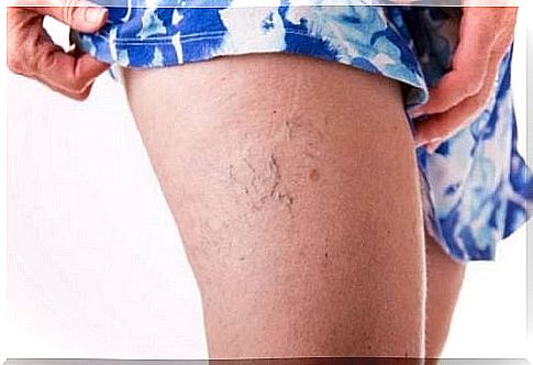 Spider veins 