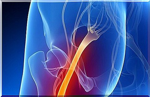 How do I know if I have sciatica?