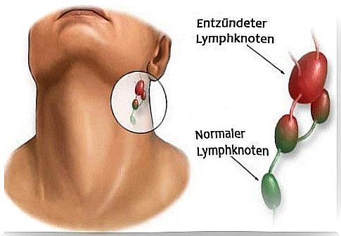 Inflammation of the lymph nodes