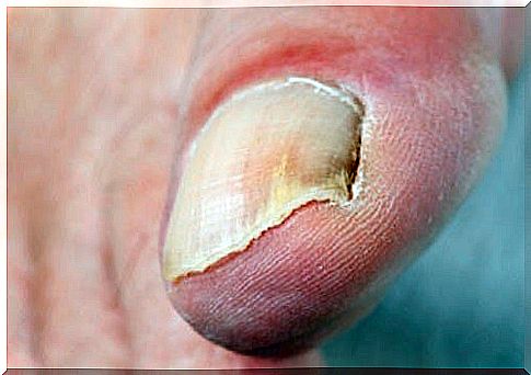 Nail Diseases - Causes and Treatment Options