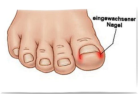 ingrown nail