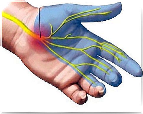 Natural Remedies for Carpal Tunnel Syndrome