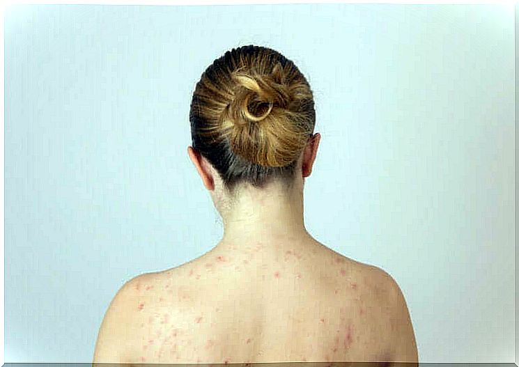 Woman has pimples on her back