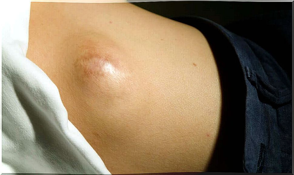 Back pimples: lipoma