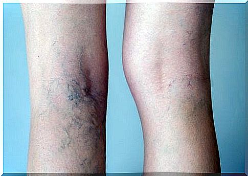 Strengthen veins and naturally prevent varicose veins