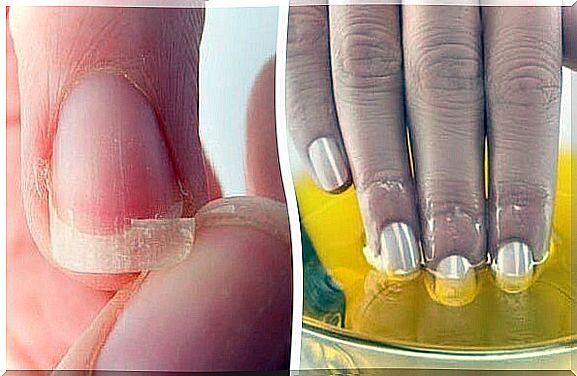 Treat nail fungus naturally