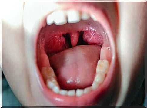 Viral pharyngitis - open mouth