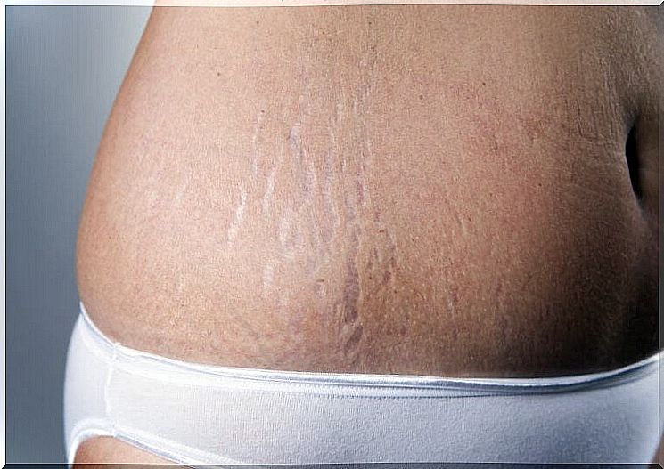 Vitamin E capsules against stretch marks