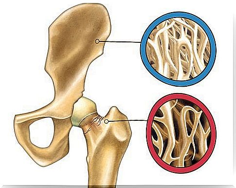 Overdosing on vitamin D damages the bones